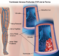 Ilustración de la trombosis venosa profunda en una pierna