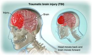 tbi diagnosis years later