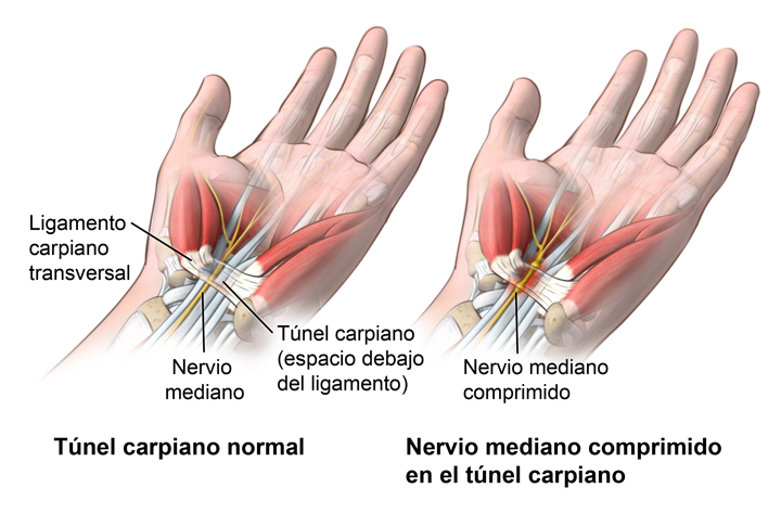 Síndrome del túnel carpiano (Carpal Tunnel Syndrome) - OrthoInfo - AAOS