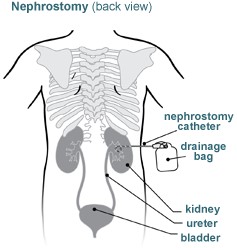 Nephrostomy Tube