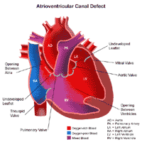 Click Image to Enlarge Anatomy of a heart with an atrioventricular canal defect
