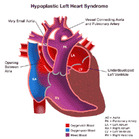 Click Image to Enlarge Anatomy of a heart with hypoplastic left heart syndrome