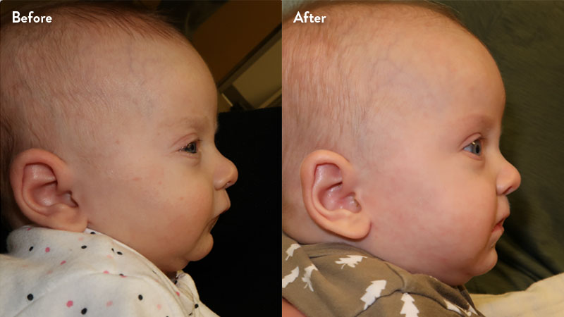 Before and after of infant with orthodontic airway plate treatment