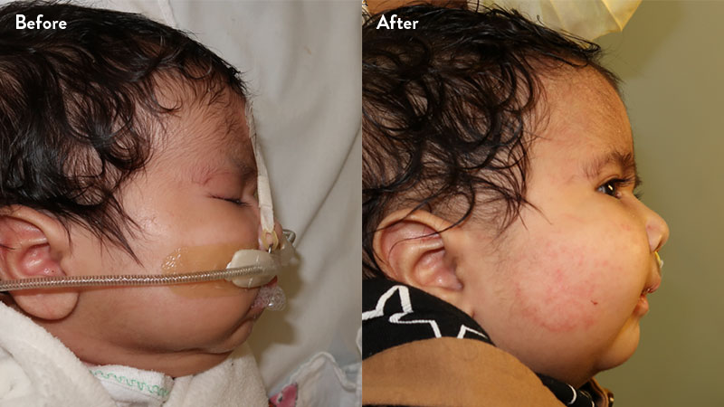 Before and after of infant with orthodontic airway plate treatment