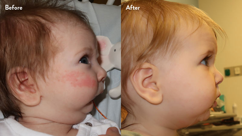 Before and after of infant with orthodontic airway plate treatment